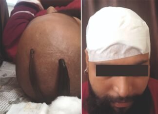 बालों के झड़ने की समस्याओं का समाधान (जोंक चिकित्सा) विधि से मिर्जापुर में शुरु