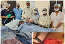 25 वर्षीय महिला के पेट से निकाला गया विशाल ट्यूमर