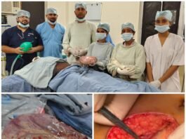 25 वर्षीय महिला के पेट से निकाला गया विशाल ट्यूमर