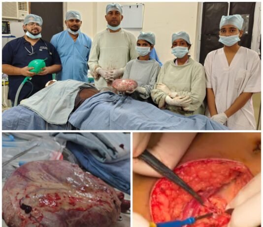 25 वर्षीय महिला के पेट से निकाला गया विशाल ट्यूमर